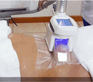 Sabias que la Terapia de frio o Cold Therapy, congela la grasa corporal, destruyendola?