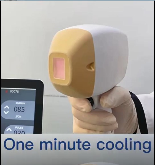 Diode laser hait removal one minute cooling.jpg