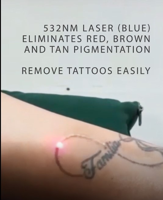 Tattoo removal.jpg
