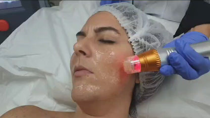 Micro-aiguille RF fractionnée petite - Réf. 1479