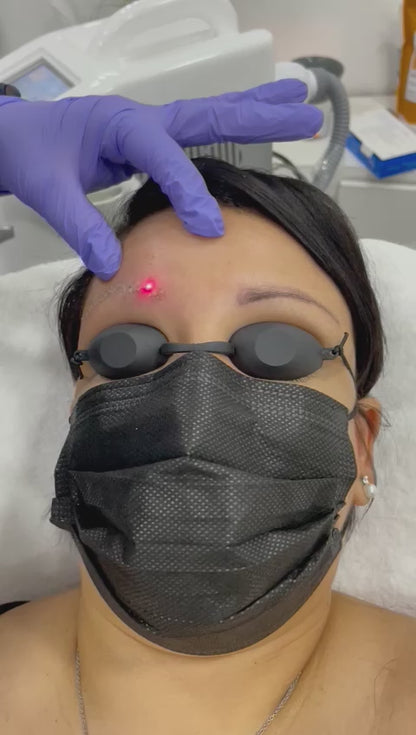 Détatouage au laser Yag - Réf. 1197